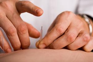 Acupuncture Treatments And Physiotherapy