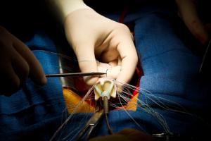 What is Heart Valve Surgery