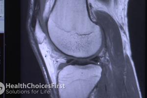 MRI Scans for Knee Injuries and When They Are Important
