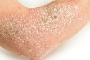 What is Psoriasis? and How Does it Effect You