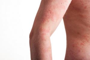 What are Your Treatment Options for Psoriasis