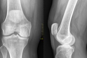 Causes of Osteoarthritis of the Knee