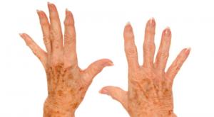 hand arthritis