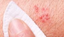 Shingles Treatment and Prevention