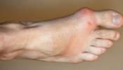 gout symptoms arthritis