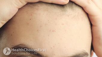 How to Treat  Adult  Acne