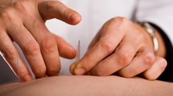 Acupuncture Treatments and Physiotherapy