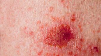 Dr. Jan Peter Dank, MD, Dermatologist, discusses the treatment of melanoma skin cancer.