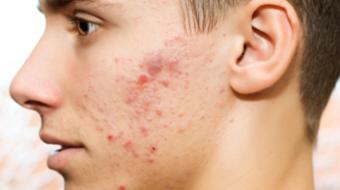 Dr. Jan Dank, MD, discusses Acne in Teenagers Verses Adults.