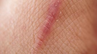 close up scar