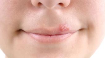 What are Cold Sores and Fever Blisters?