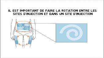 Comprendre la technique de rotation de l'insuline