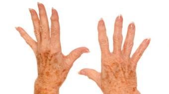 hand arthritis