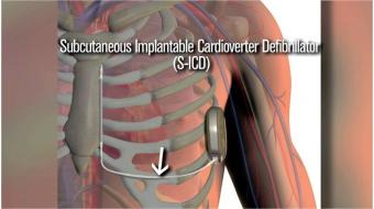heart subcutaneous defibrillator
