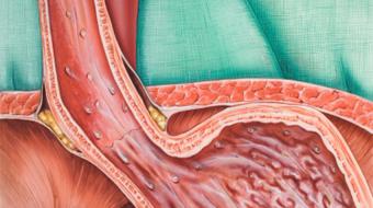 Dr. Duncan Miller, B. Sc, MD, discusses gastroesophageal reflux disease and heartburn.