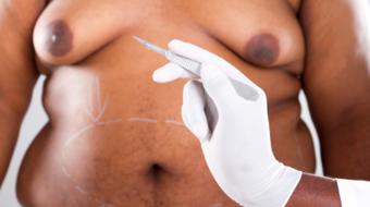 Dr. Jason Rivers, MD, FRCPC, discusses Who is Eligible for Body Contouring.
