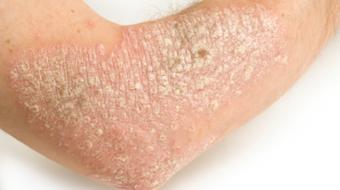 Dr. Jan Peter Dank, MD, Dermatologist, discusses What is Psoriasis? and How Does it Effect You.