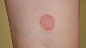 round skin rash