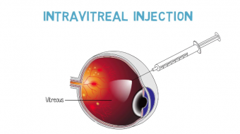 Dr. Amit Gupta, MD, FACS, Ophthalmologist, talks about the steps involved and potential side effects when getting an intravitreal injection.