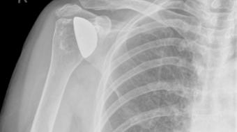 What Are Commonly Used  Shoulder Replacement Materials