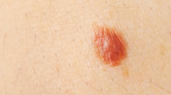 Dr. Jan Peter Dank, MD, Dermatologist, discusses the ABCDE's of melanoma.