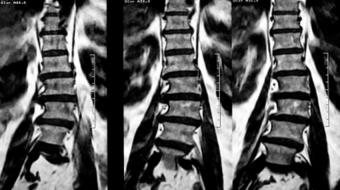 spinal scoliosis