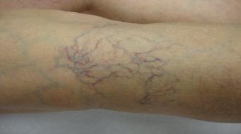 vericose veins spider veins