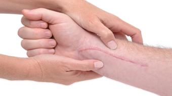 wrist carpel tunnel surgery scar