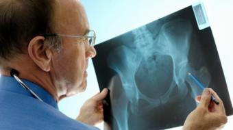Preventing bone loss during cancer treatment