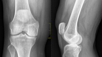 Dr. Bassam Masri, MD, FRCSC, Orthopedic Surgeon, discusses the causes of osteoarthritis of the knee.