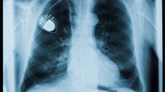 xray pacemaker