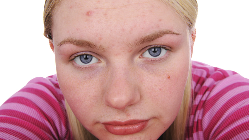 acne girl