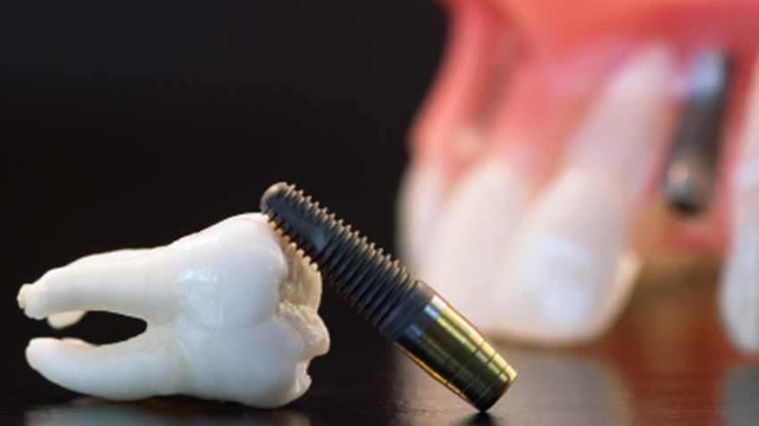 dental implant injury