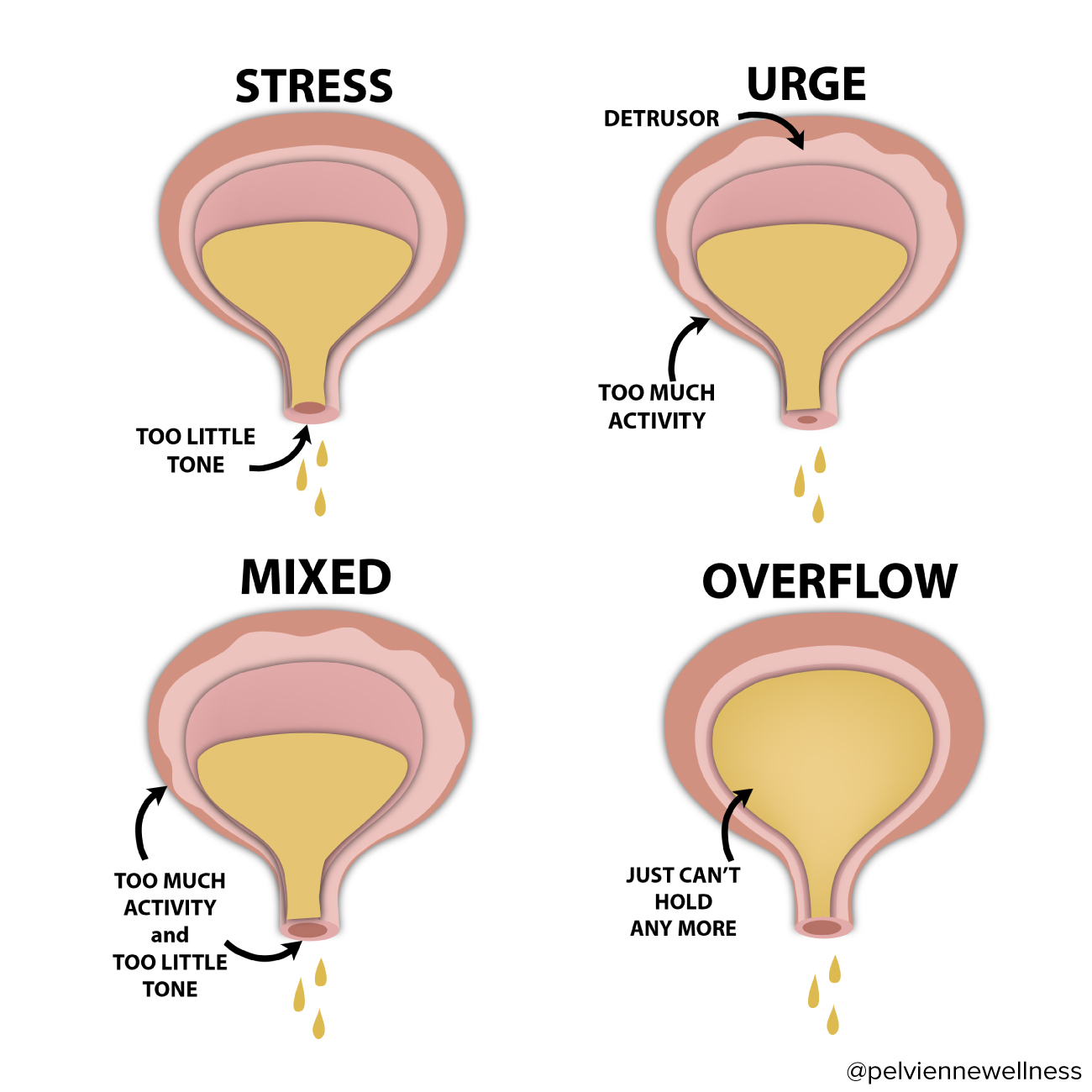 Incontinence Types Health Choices First