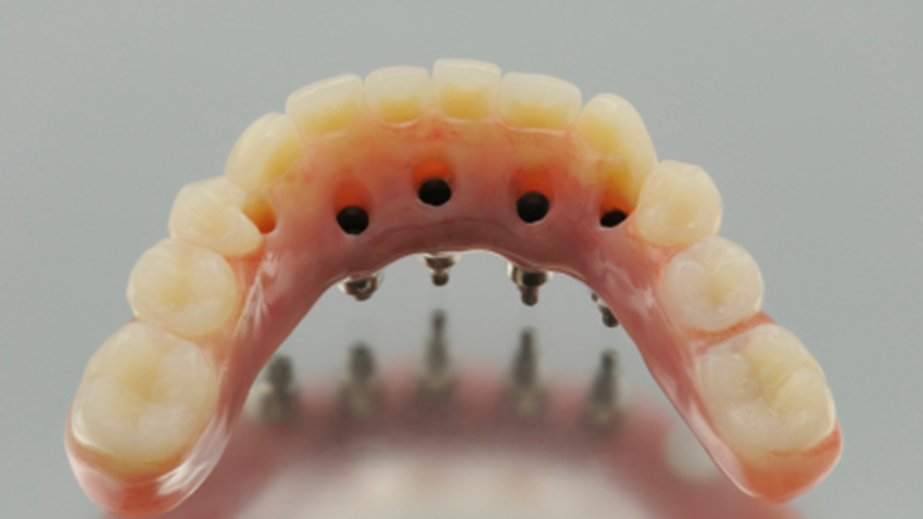 procedures implant dental