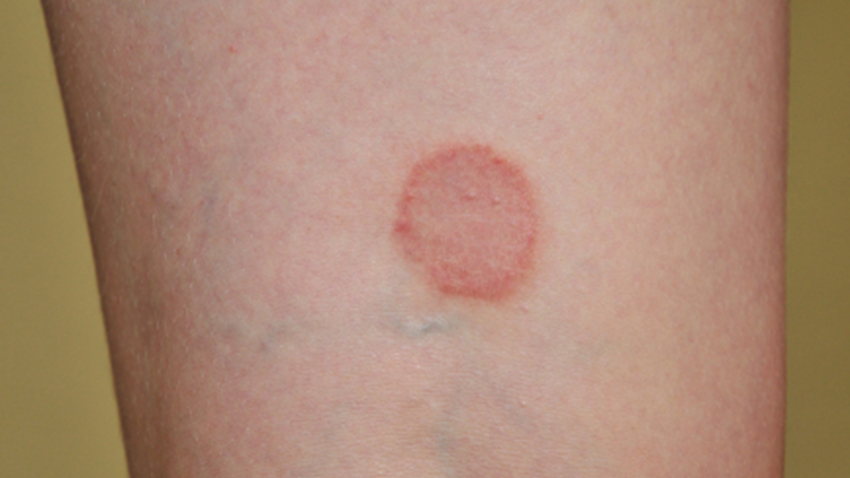 round skin rash