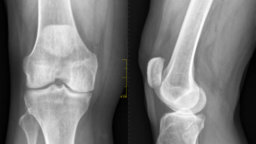 /uploads/videothumbs/xray_knee_joints.jpg